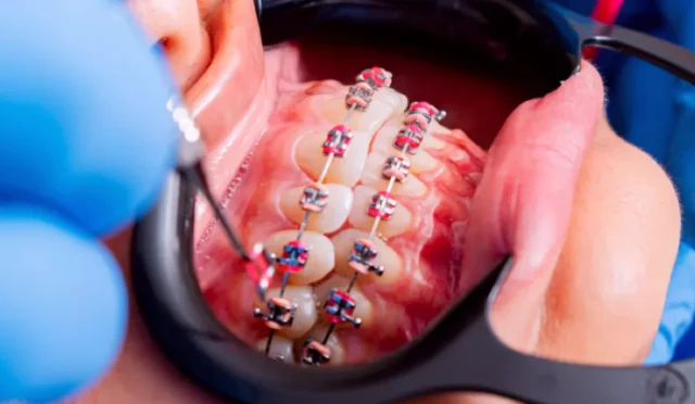Diş Teli Fiyatları 2026: İstanbul'da Tedaviye Başlamadan Bilmeniz Gerekenler!